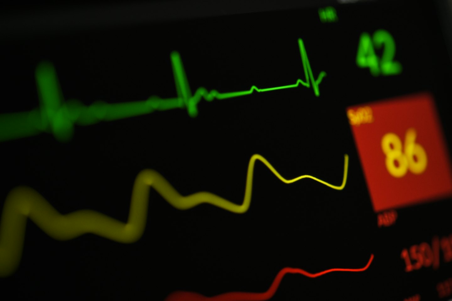 Medical monitor screen showing vital signs and waveforms.